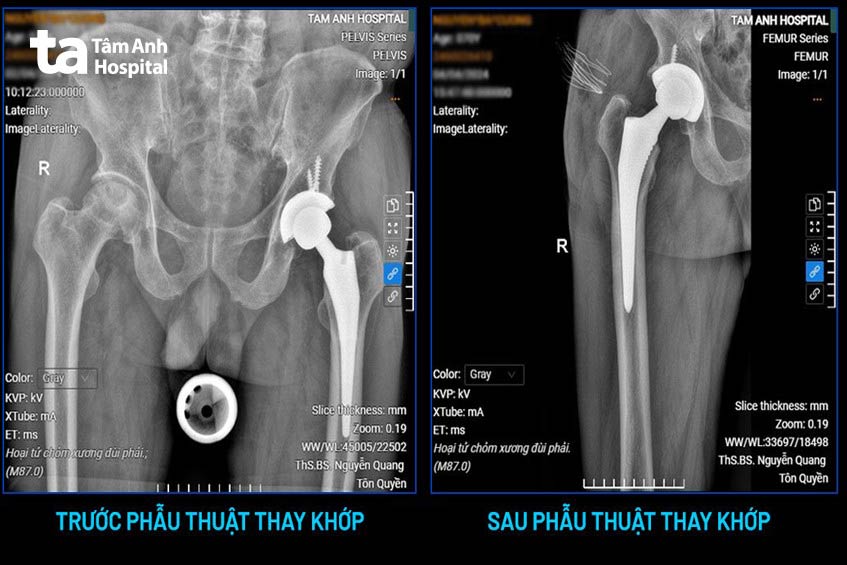Ảnh chup x quang trước và sau phẫu thuật