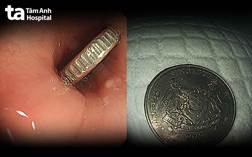 Ảnh nội soi đồng xu mắc kẹt trong thực quản