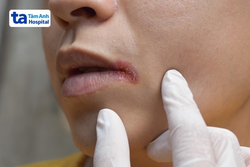 B12 Ankermann 1000mcg là thuốc gì?