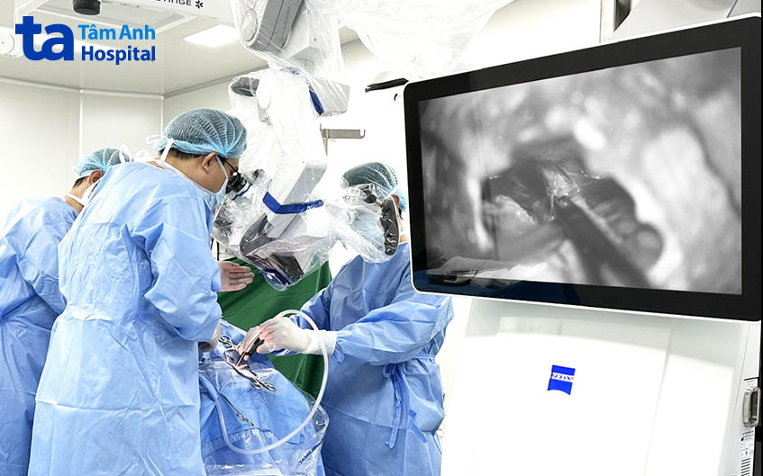 Các bác sĩ tách động mạch tiểu não trên ra khỏi dây thần kinh tam thoa cho người bệnh