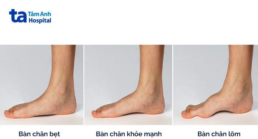 Bàn chân bẹt bàn chân lõm