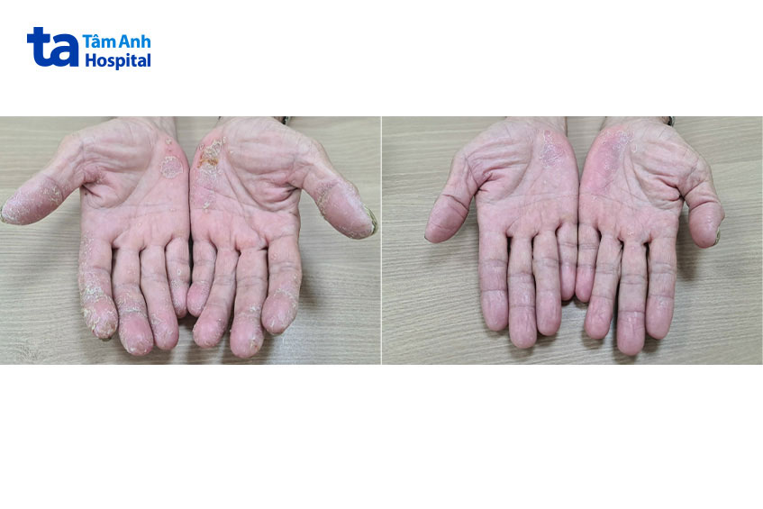 Bàn tay ông Q trước và sau 1 tháng điều trị