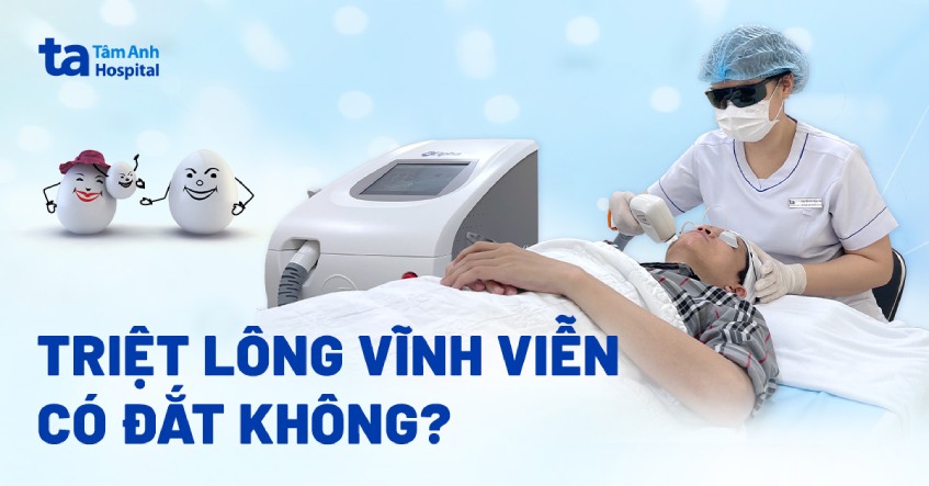 Bảng giá triệt lông vĩnh viễn bao nhiêu tiền? Có đắt không?