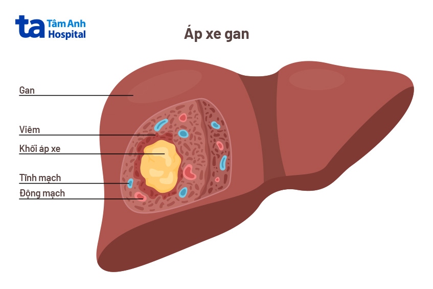 bệnh áp xe gan