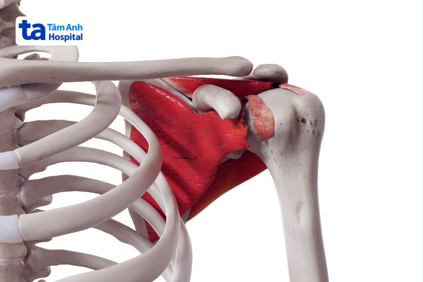 bệnh gây sưng tấy và đau nhức ở vai