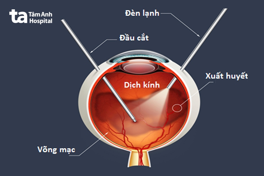 bệnh lỗ hoàng điểm