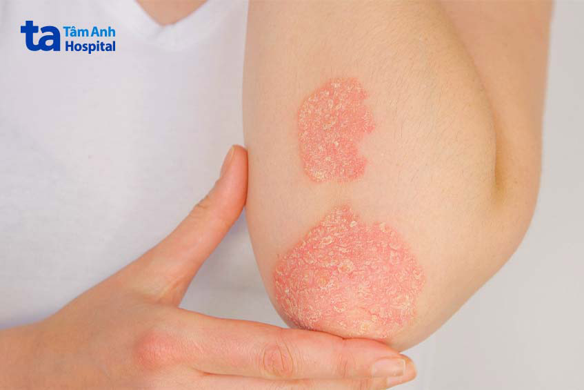 bệnh viêm khớp do vảy nến