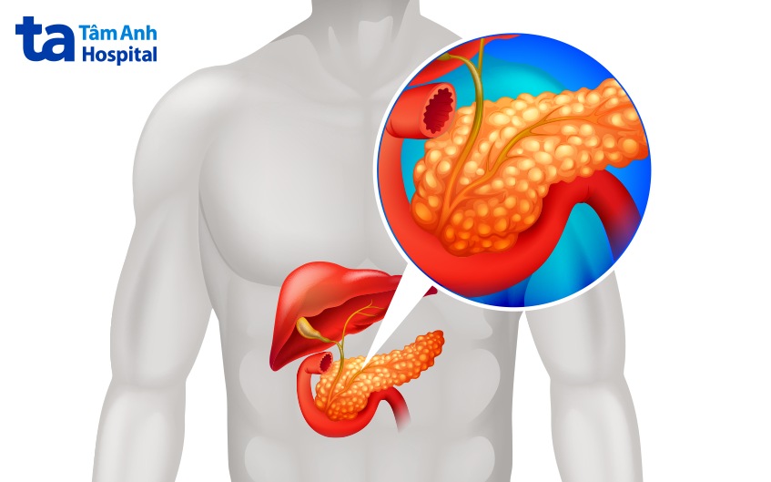 bị bệnh suy tụy