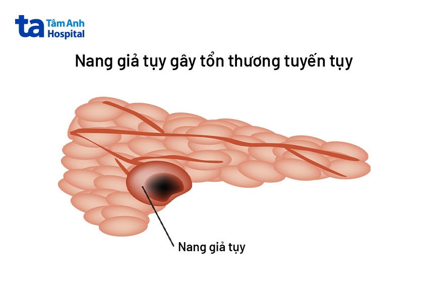 bị nang giả tụy
