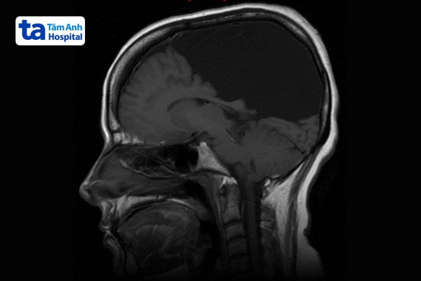 bị nang màng nhện có nguy hiểm không