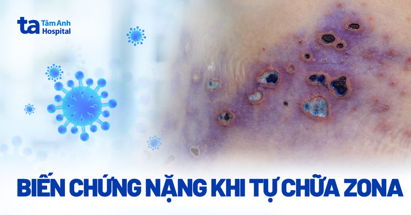 Biến chứng nặng khi tự chữa zona