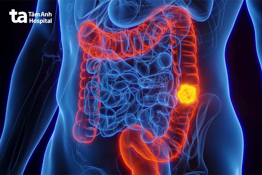 biến chứng rò hậu môn