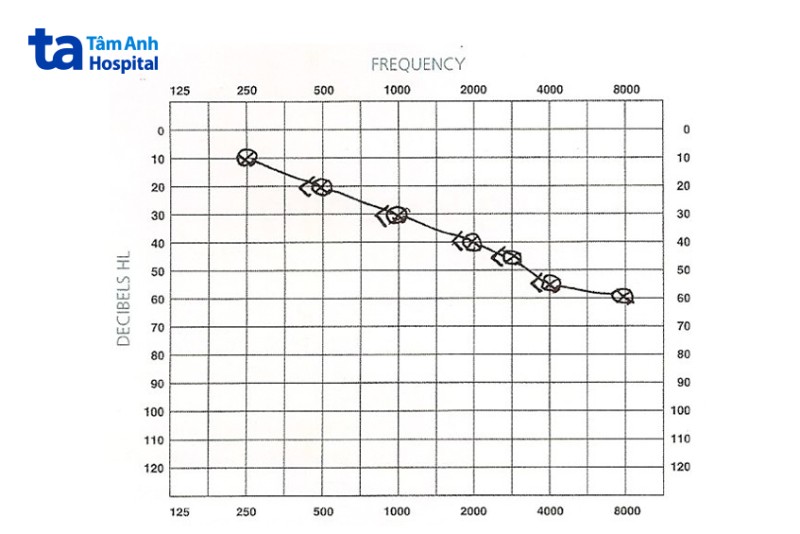 Thính lực đồ của người mất thính lực tiếp nhận thần kinh 