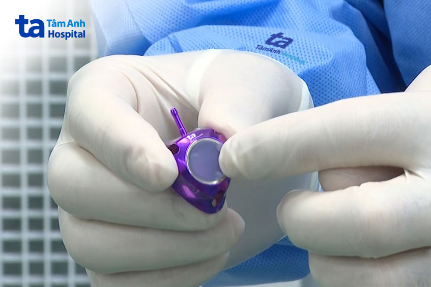 Buồng tiêm titan được dùng đặt dưới da cho bệnh nhân ung thư