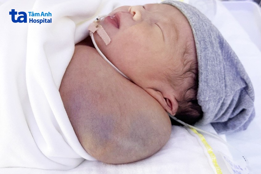 Bướu bạch huyết to khi bé chào đời