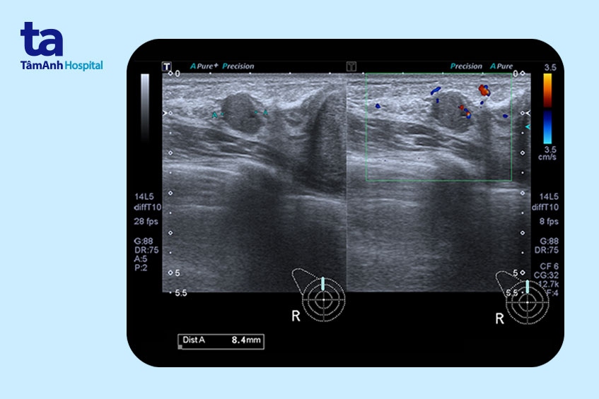 bướu sợi tuyến