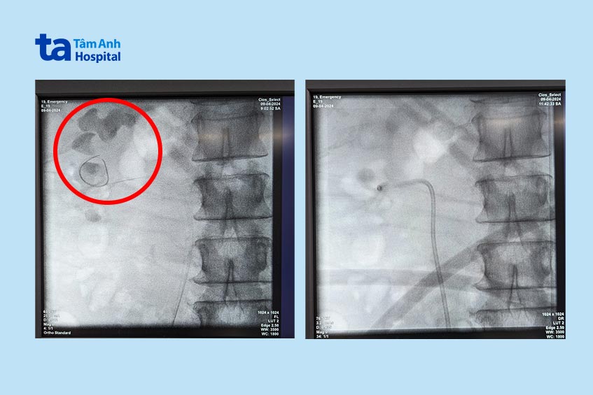 c-arm chụp thận trước và sau tán sỏi