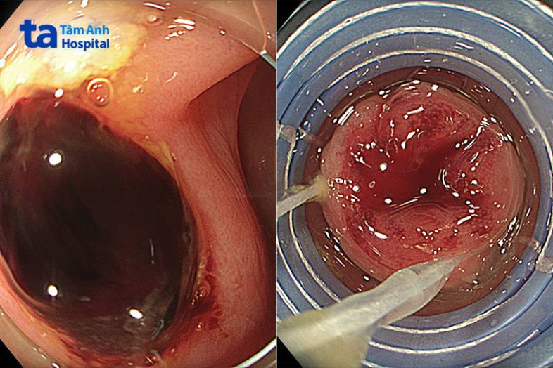 ca nội soi thắt túi thừa