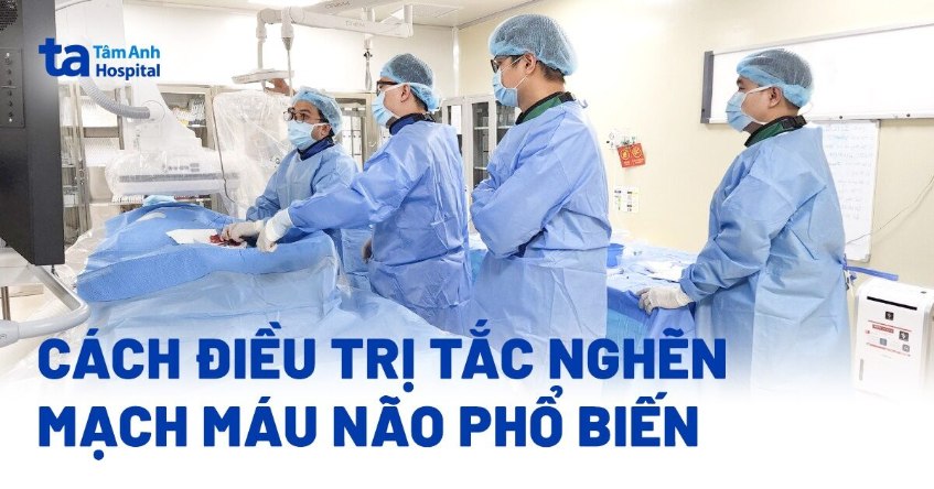 3 cách điều trị tắc nghẽn mạch máu não phổ biến hiện nay