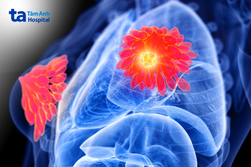 cách điều trị ung thư vú dương tính HER2