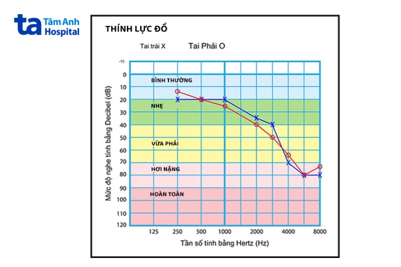 Thính lực đồ là gì?
