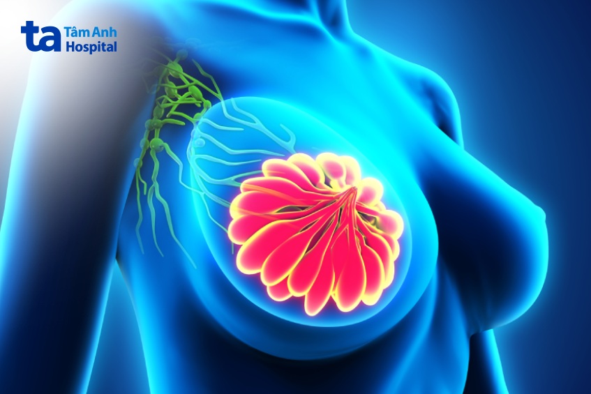 cách phát hiện u vú