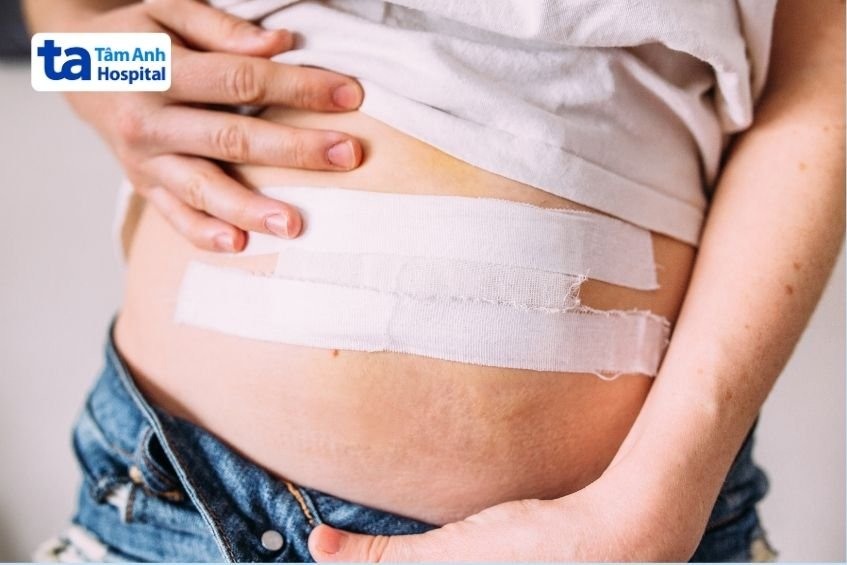 chăm sóc sau mổ thoát vị thành bụng