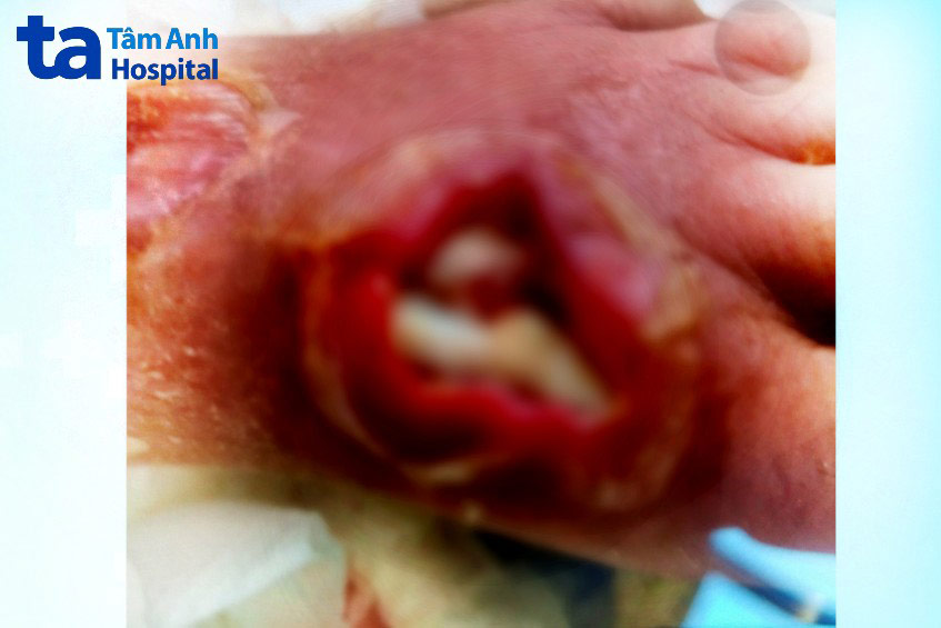 Chân bà h loét lòi gân trắng khi tự điều trị tại nhà