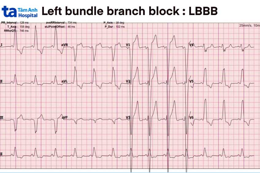 Chẩn đoán block nhánh trái thông qua kết quả điện tâm đồ