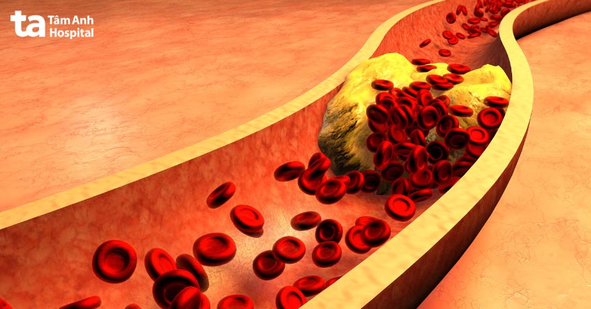 Cholesterol tích tụ tạo thành mảng bám gây tắc nghẽn động mạch vành