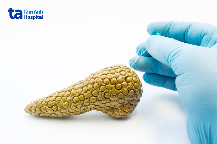 chữa nang giả tụy