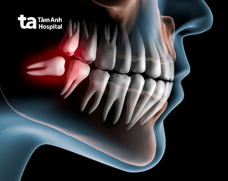 Có nên nhổ răng số 8 hàm dưới không?