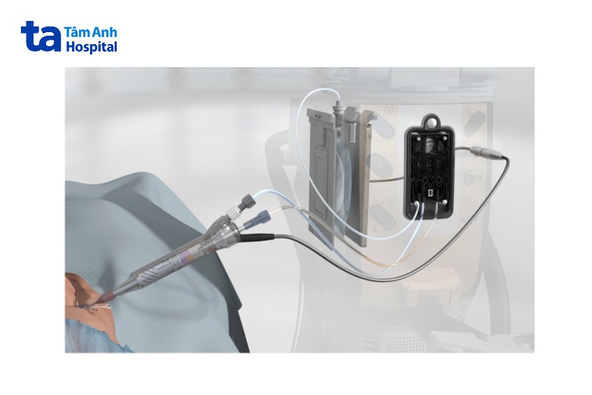 công nghệ active fluidics với tay cầm active sentry