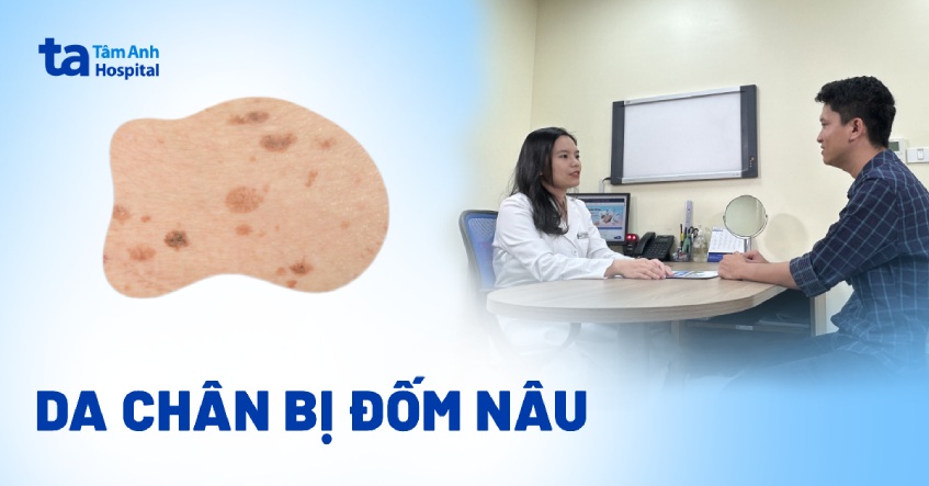 da chân bị đốm nâu