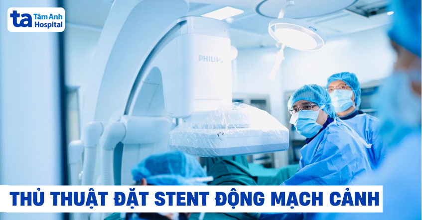 Đặt stent động mạch cảnh: Quy trình, chỉ định và chống chỉ định