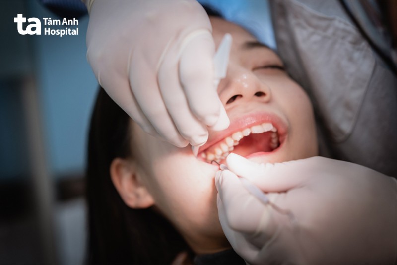 Cách giảm nhẹ các dấu hiệu mọc răng khôn hàm trên