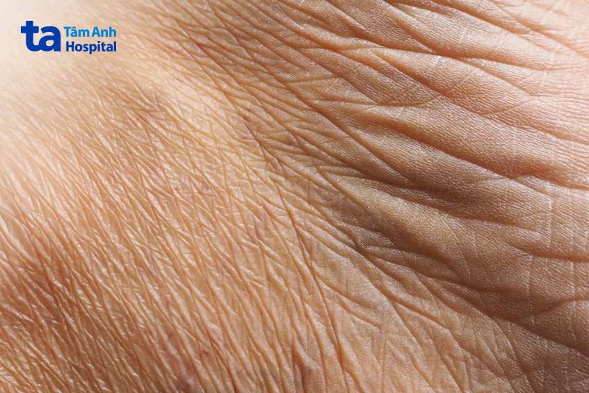 dấu hiệu nhận biết nếp nhăn