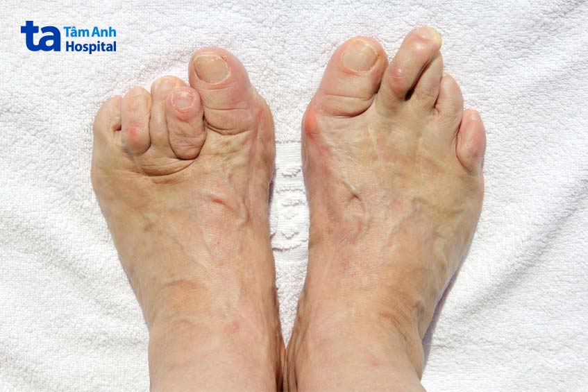 Dị tật bàn chân co rút không thể đi lại 