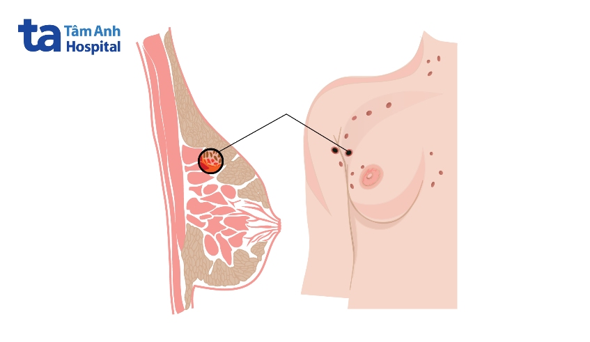 điều trị her2 dương tính