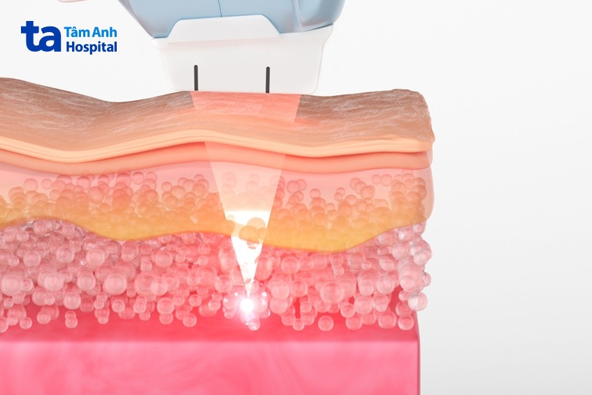 điều trị nám chân đinh