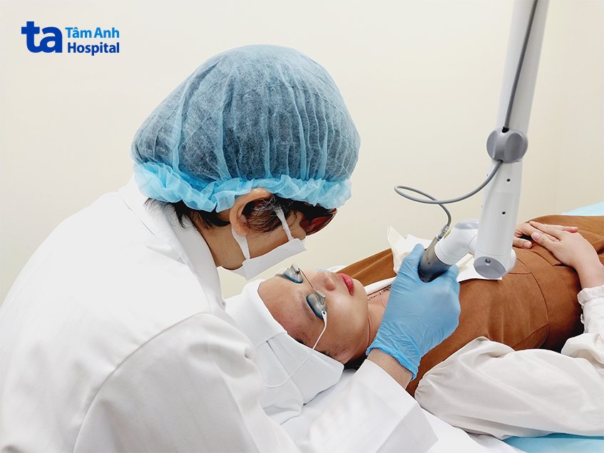 điều trị nám da mặt vùng má