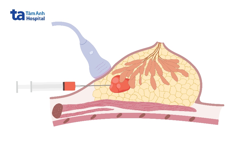 điều trị ung thư vú dương tính HER2