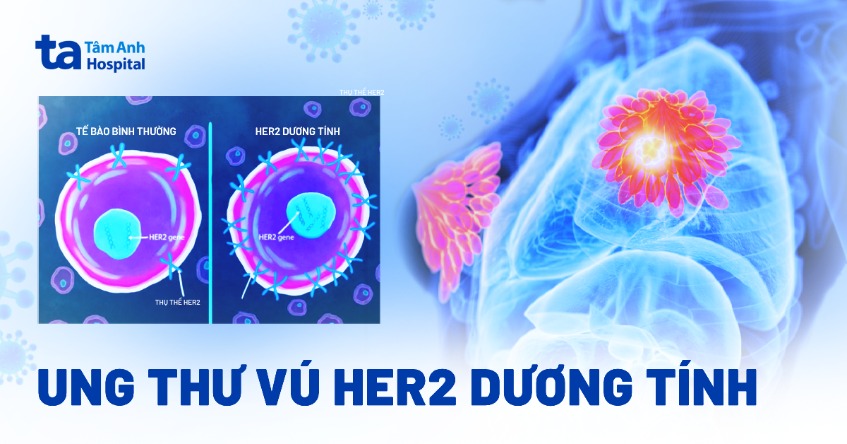 điều trị ung thư vú HER2 dương tính