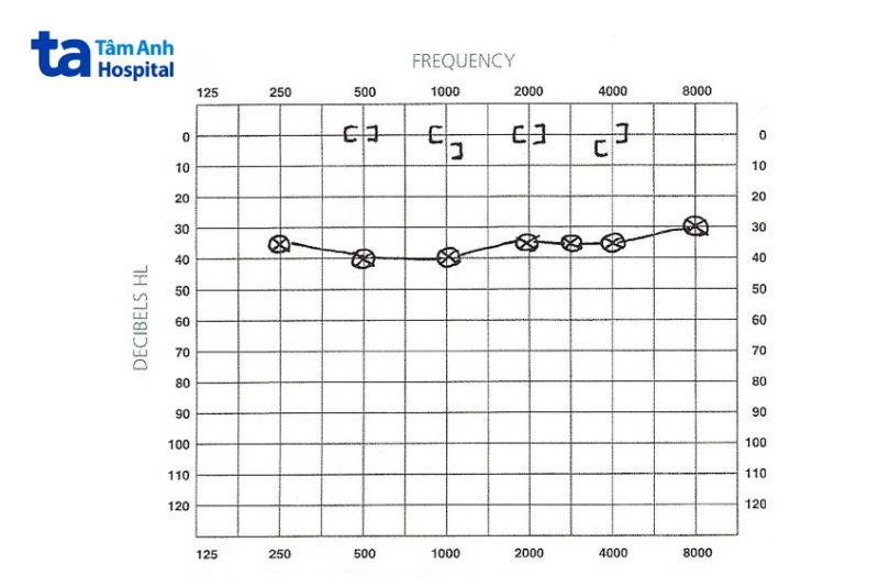 Thính lực đồ của người mất thính lực dẫn truyền