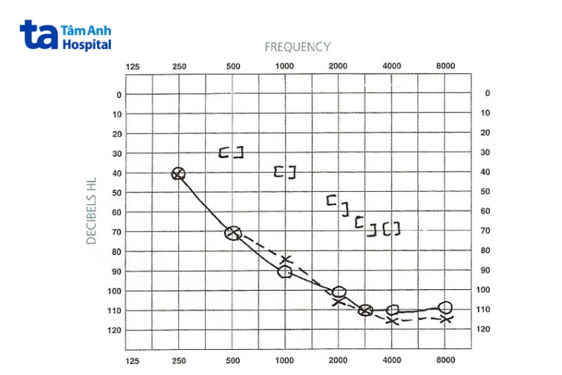 Thính lực đồ của người mất thính lực hỗn hợp