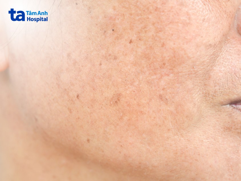 đối tượng dễ bị nám vùng má