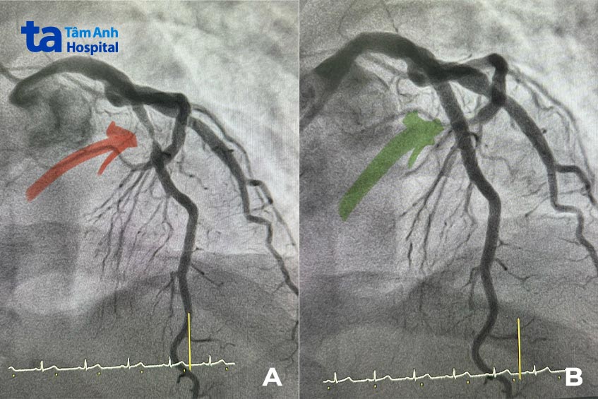 Dòng chảy qua động mạch liên thất trước bị chặt đứt gần hết (hình A) và sau khi được đặt stent khơi thông (hình B)