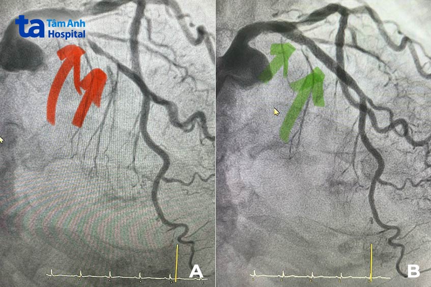 Dòng máu qua động mạch liên thất trước bị chặn gần hết (hình A) và được khơi thông sau khi đặt stent (hình B)