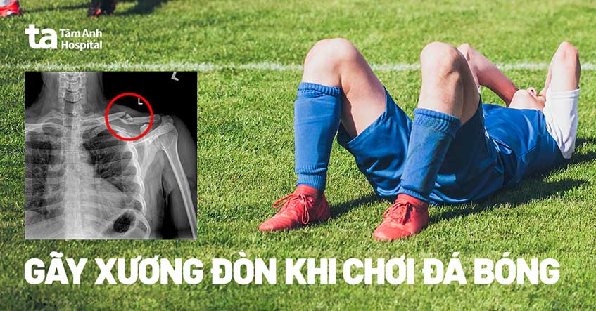 Gãy xương đòn khi chơi đá bóng