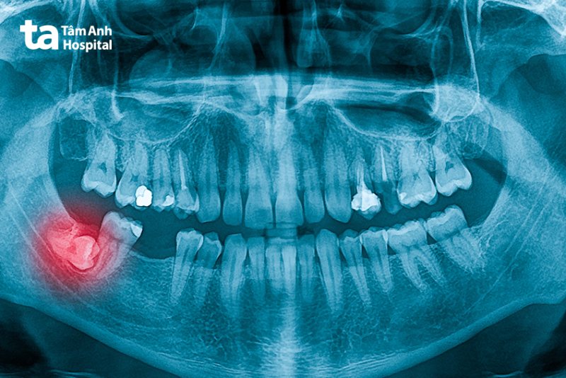 Mọc răng khôn đau mấy ngày mới hết?